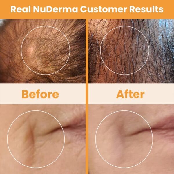 NuDerma wand used for scalp and hair stimulation – promotes hair health and clarity
